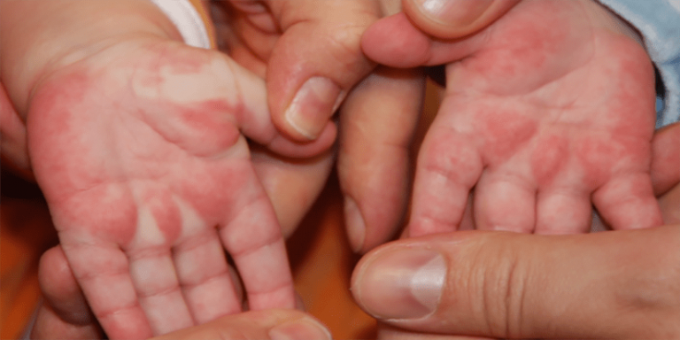 කවසාකි රෝගයට බියවිය යුතු නෑ