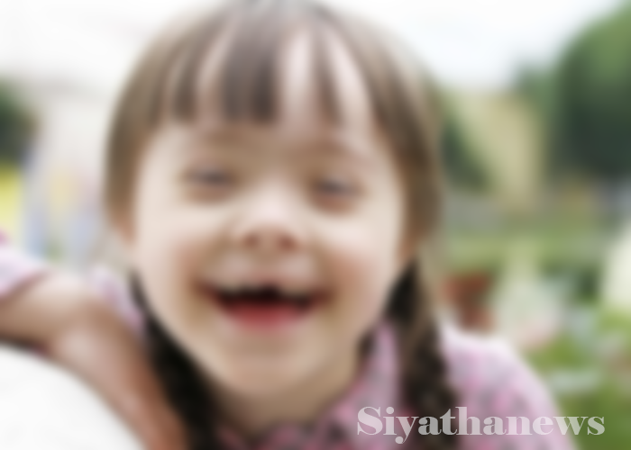 අද ලෝක ඩවුන් සින්ඩ්‍රෝම් දිනයයි