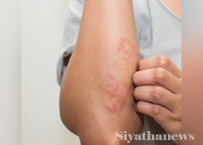 වියළි කාලගුණයත් සමග විවිධ රෝග, සමේ පිළිකා ඇතිවීමේ අවධානමක් (VIDEO)