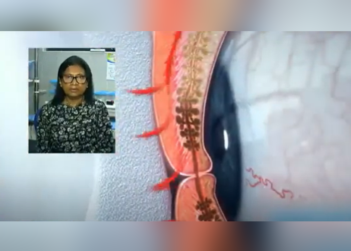 අධික උෂ්ණත්වය නිසා ඇස් අන්ධ වීමේ අවදානමක් – නොමේරු දරු උපත් ද 60%කින් ඉහළට (VIDEO)