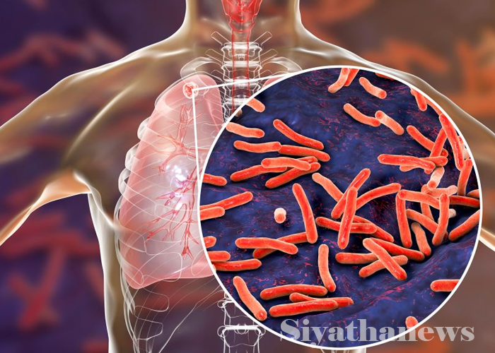 මෙරට ක්ෂය රෝගීන් වාර්තා වීම 14% කින් ඉහළට (VIDEO)